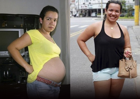 Jovem que parecia grávida tinha na verdade um cisto gigante