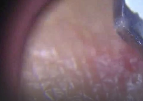 Vídeo mostra o que acontece quando retiramos um pêlo inflamado da pele