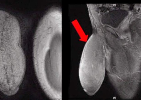  Jovem faz cirurgia para diminuir tamanho do pênis
