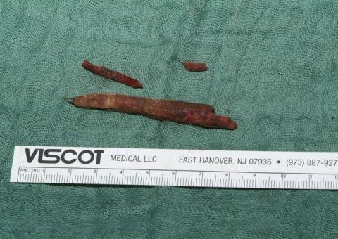  Homem viveu anos com um lápis na cabeça