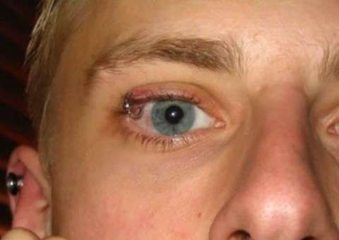 A nova moda nos EUA é pálpebras perfuradas