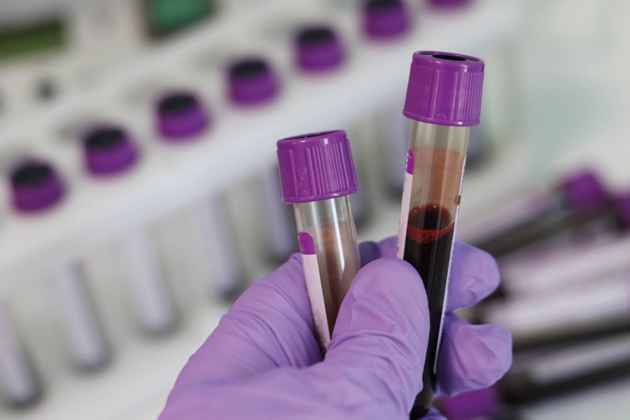 Amazonas registra 81 novos casos de Covid em apenas 1 dia