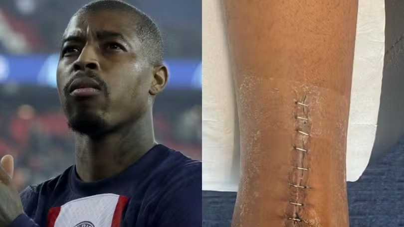 Zagueiro Kimpembe, do PSG, impressiona web com tendão de Aquiles operado