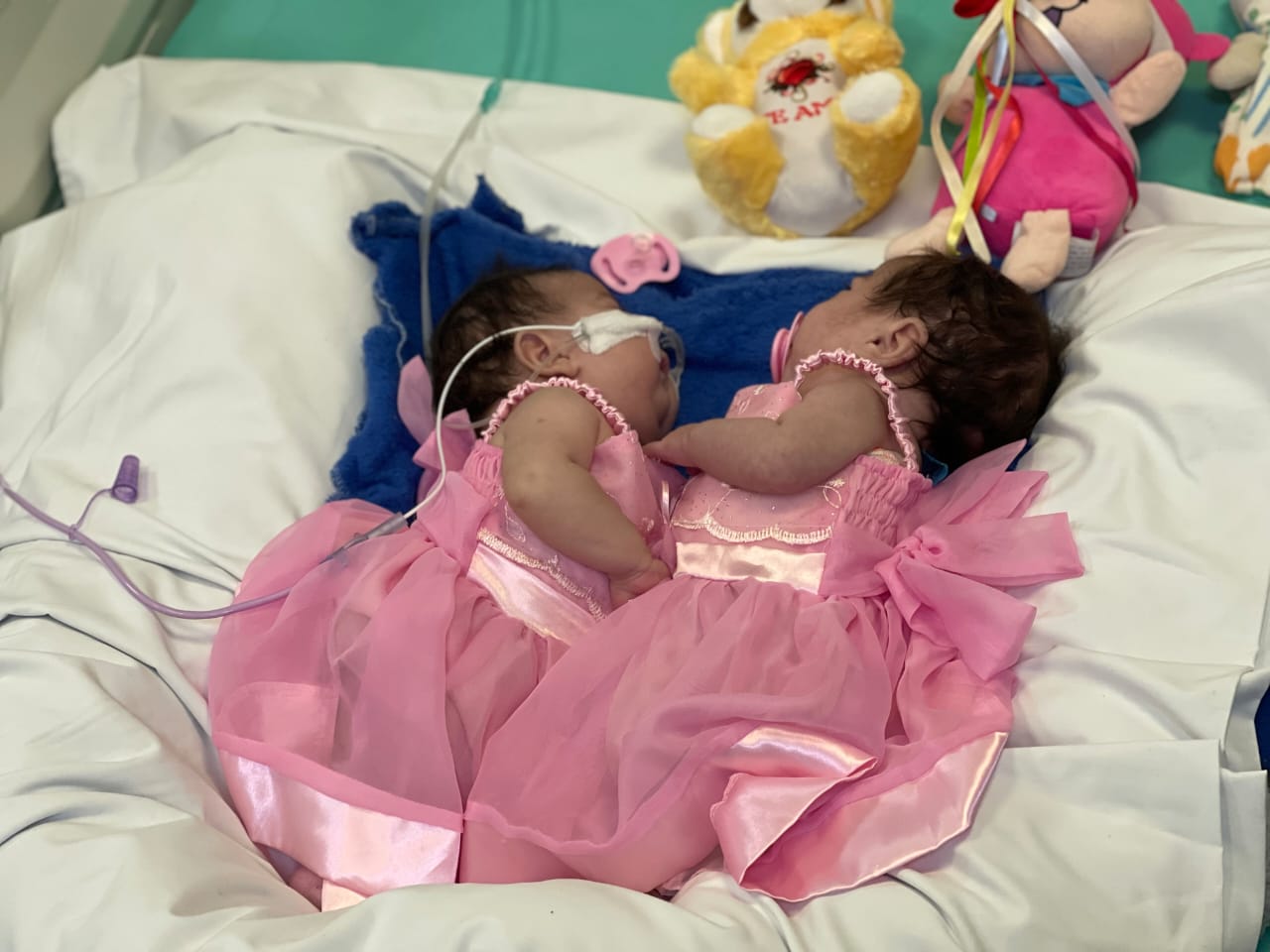 Gêmeas siamesas do Amazonas recebem alta da UTI após cirurgia de separação