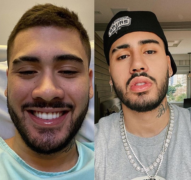 Kevinho se empolga com resultado de plástica no nariz: 'to chocado'