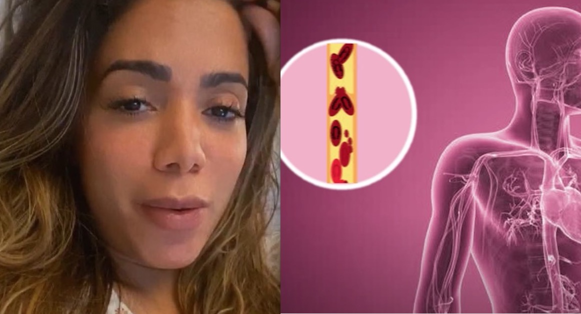 Saiba o que é trombose, doença pode levar à morte e fez Anitta ser internada