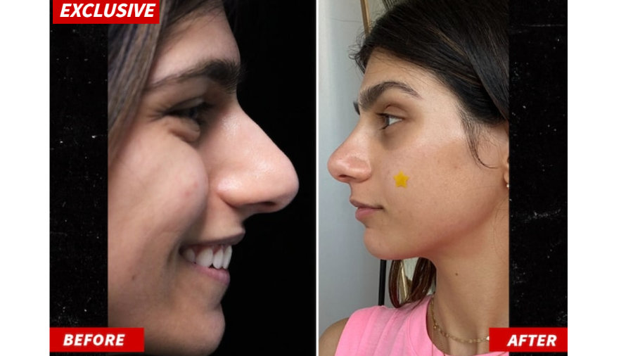 Ex-atriz pornô Mia Khalifa impressiona com antes e depois de rinoplastia