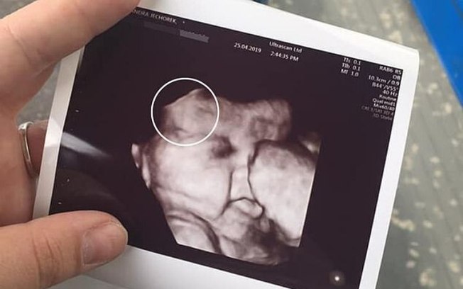 Grávida faz ultrassom e fica chocada com o que vê em bebê