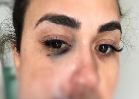 Mulher que teve rosto desfigurado por modelo em restaurante de luxo mostra reconstrução 