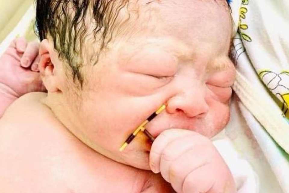 Saiba a verdade sobre o bebê que nasceu segurando um DIU