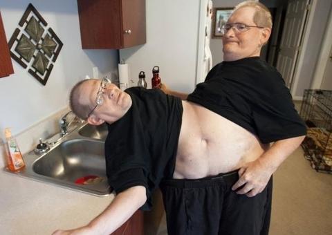 Gêmeos siameses mais velhos do mundo morrem aos 68 anos