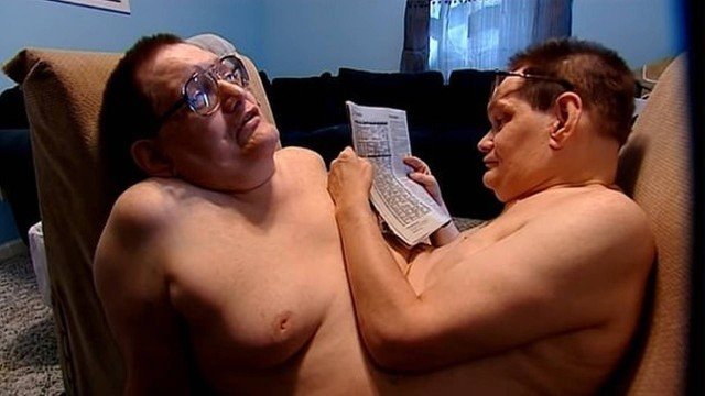 Gêmeos siameses morrem aos 68 anos