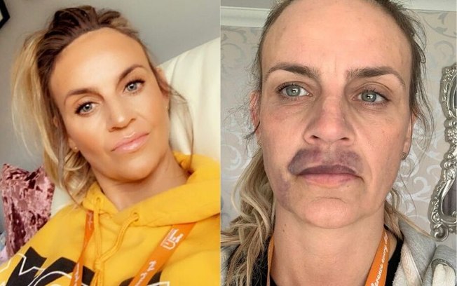 Mulher faz procedimento estético e resultado assusta