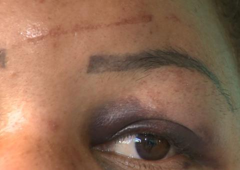 Auxiliar de serviços gerais quase tem orelha arrancada pelo namorado durante agressão