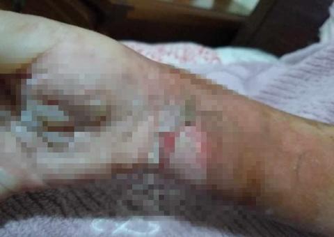 Celular explode e criança de 5 anos fica em 'chamas'