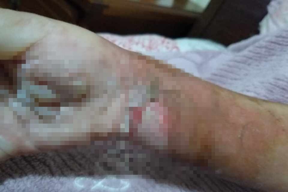 Celular explode e criança de 5 anos fica em 'chamas'