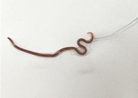 Mulher vai ao hospital com dor de garganta e descobre verme na amígdala