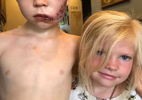 Menino arrisca a própria vida para salvar irmã de ataque de cão; rosto ficou desfigurado