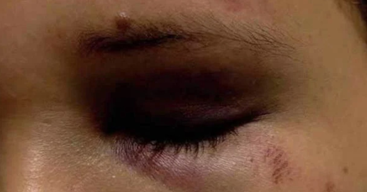 Mãe é agredida a socos após se negar a fazer comida para filha de 21 anos