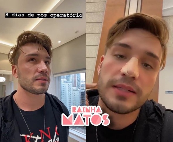 Ex-A Fazenda Lucas Viana passa por cirurgia no nariz e mostra resultado 