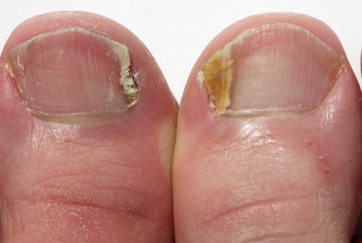 Mitos e verdades sobre a micose