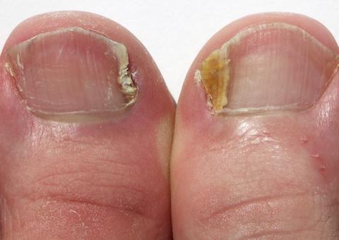 Mitos e verdades sobre a micose