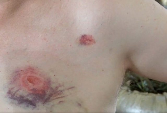 Homem é mordido no peito após corrigir passageiro sobre uso correto de máscara 