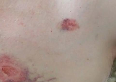 Homem é mordido no peito após corrigir passageiro sobre uso correto de máscara 