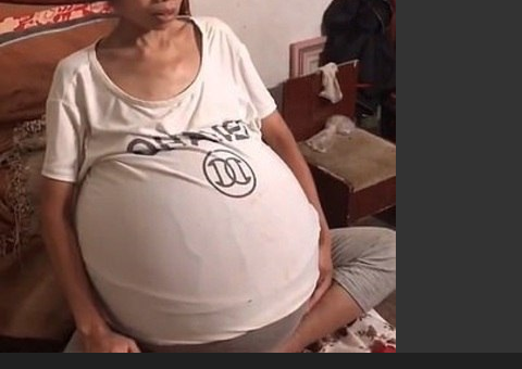 Barriga de mulher cresce misteriosamente sem parar e intriga especialistas