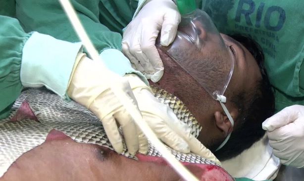 Brasileiros querem enviar pele de tilápia para tratar feridos em Beirute