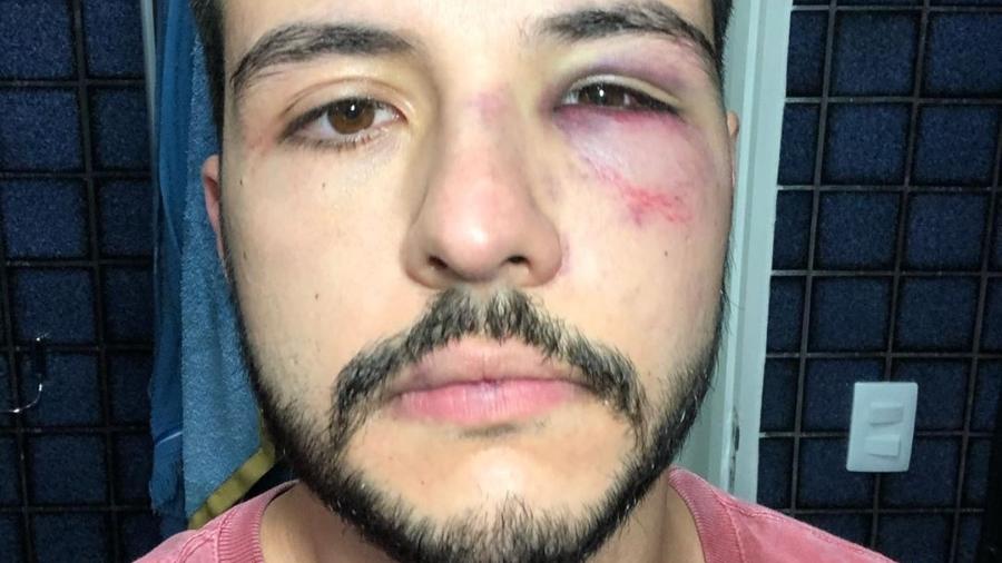 Repórter da Record é agredido após reagir a assalto e mostra olho roxo 