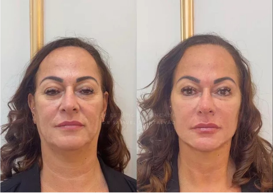 Mãe de Neymar surge em antes e depois de harmonização