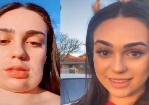 Jovem viraliza ao mostrar resultado de procedimento estético no queixo