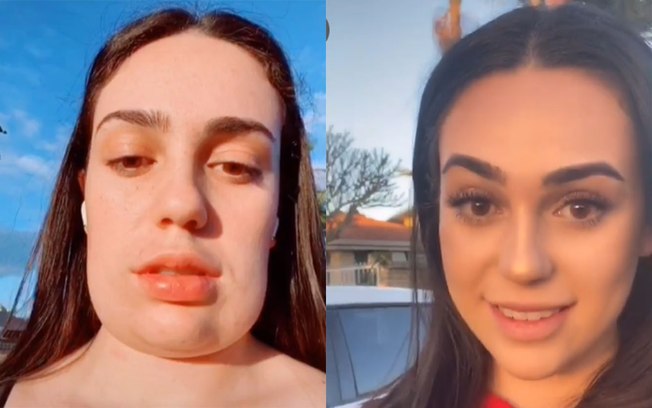 Jovem viraliza ao mostrar resultado de procedimento estético no queixo