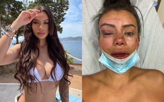 Modelo de 'De Férias com o Ex' tem nariz quebrado em festa e fotos impressionam  