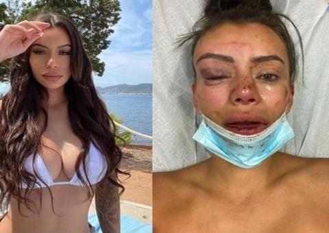 Modelo de 'De Férias com o Ex' tem nariz quebrado em festa e fotos impressionam  