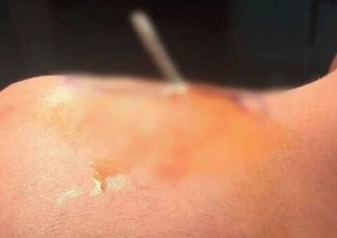 Terrível acidente deixa criança com barra de ferro preso na nuca