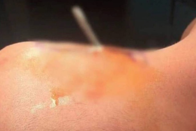 Terrível acidente deixa criança com barra de ferro preso na nuca