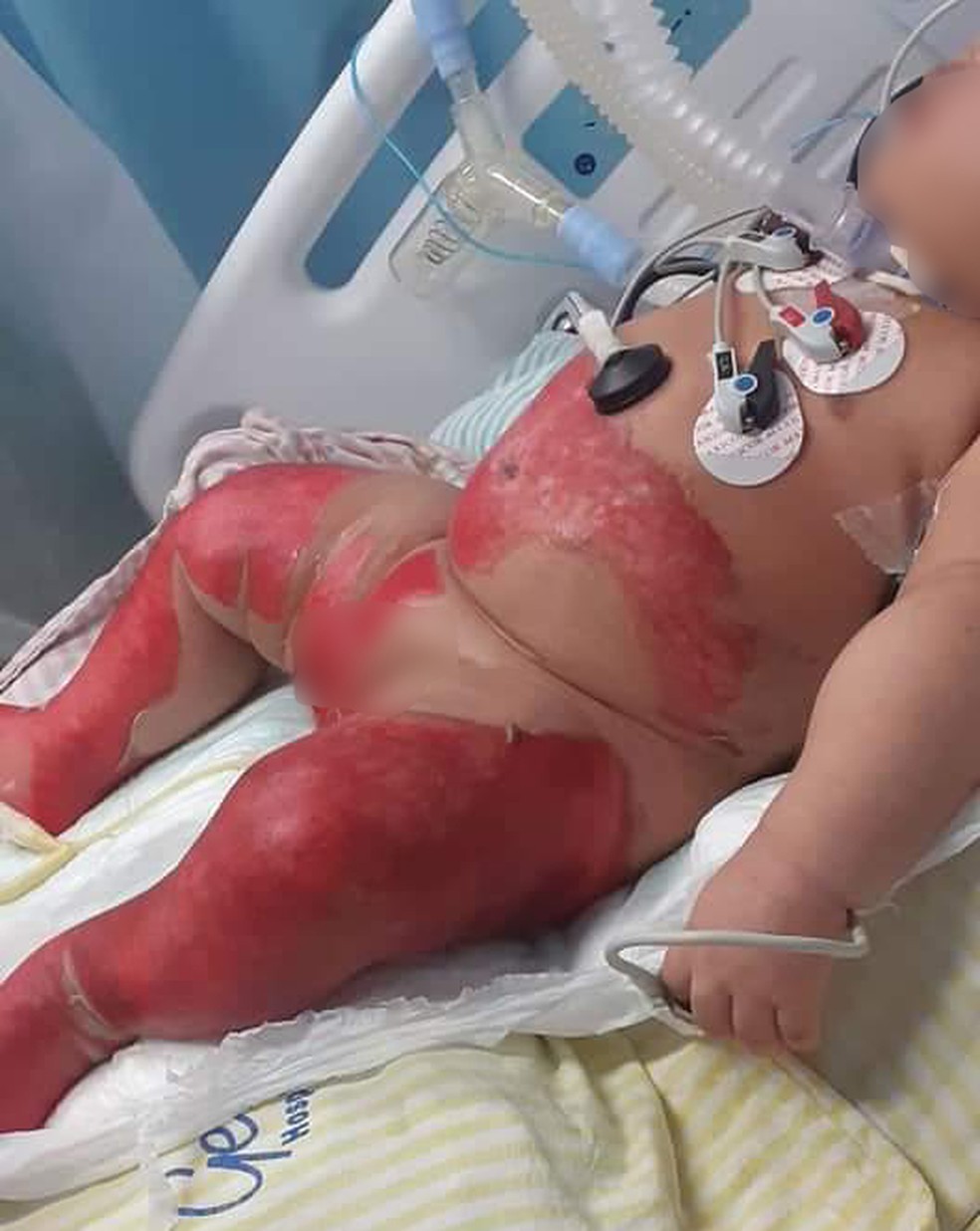 Bebê de 6 meses sofre queimaduras durante banho em hospital 