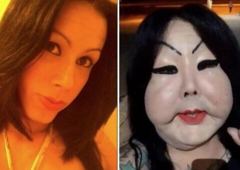 Mulher coloca silicone industrial no rosto e desabafa: me chamam de 'fofão'