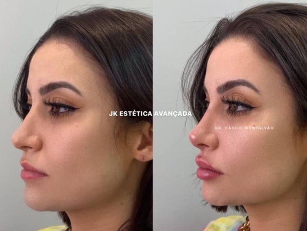 Bianca Andrade faz novos procedimentos no nariz e boca; Veja resultado 