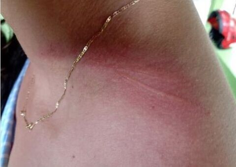 Professora da Ufam e mãe são atingidas no pescoço por linha de cerol 