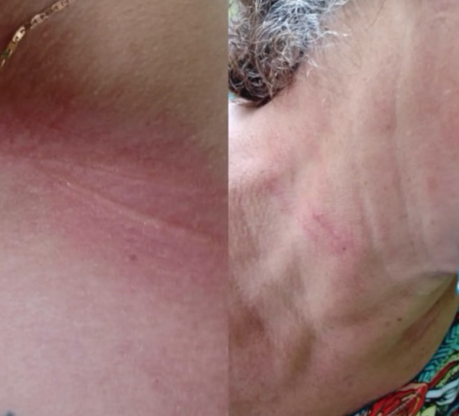 Professora da Ufam e mãe são atingidas no pescoço por linha de cerol 