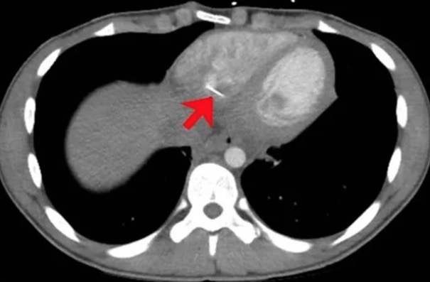 Adolescente engole alfinete e tem coração perfurado