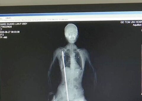 Mulher cai e tem corpo perfurado com barra de aço de quase 1 metro