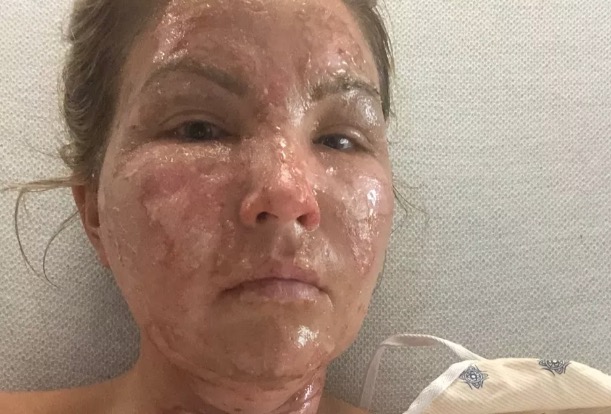 Mulher pega fogo após passar álcool em gel no corpo e acender incenso