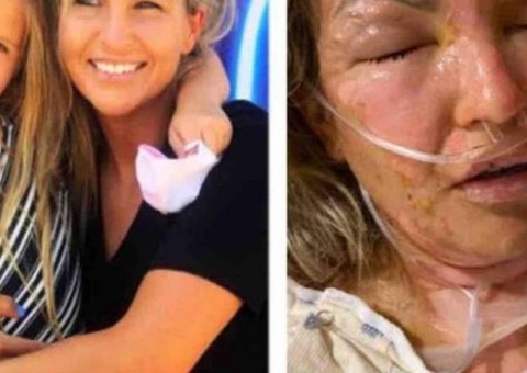 Mulher tem corpo incendiado após usar álcool gel e tentar acender vela 