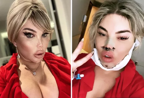 Jéssica Alves, o Ken Humano, fica com buraco no queixo após procedimento