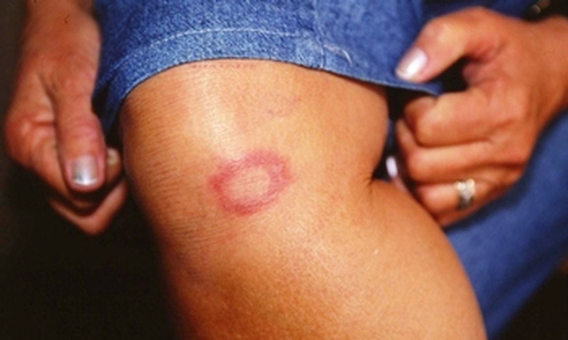 Governo capacitará profissionais da saúde para identificar Hanseníase