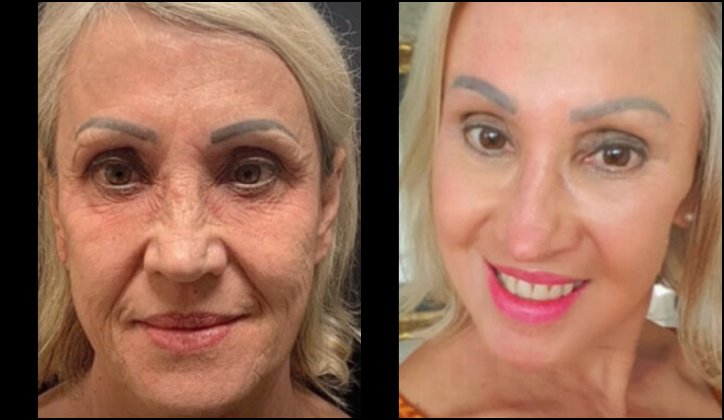 Peeling de fenol custa R$ 30 mil e promete rejuvenescer anos em uma sessão